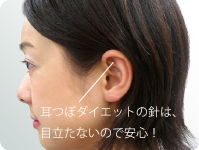 耳つぼダイエットの鍼は、目立たないので安心